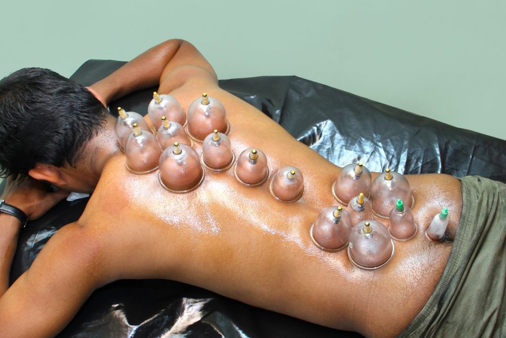 Things You Should Know About Cupping Therapy