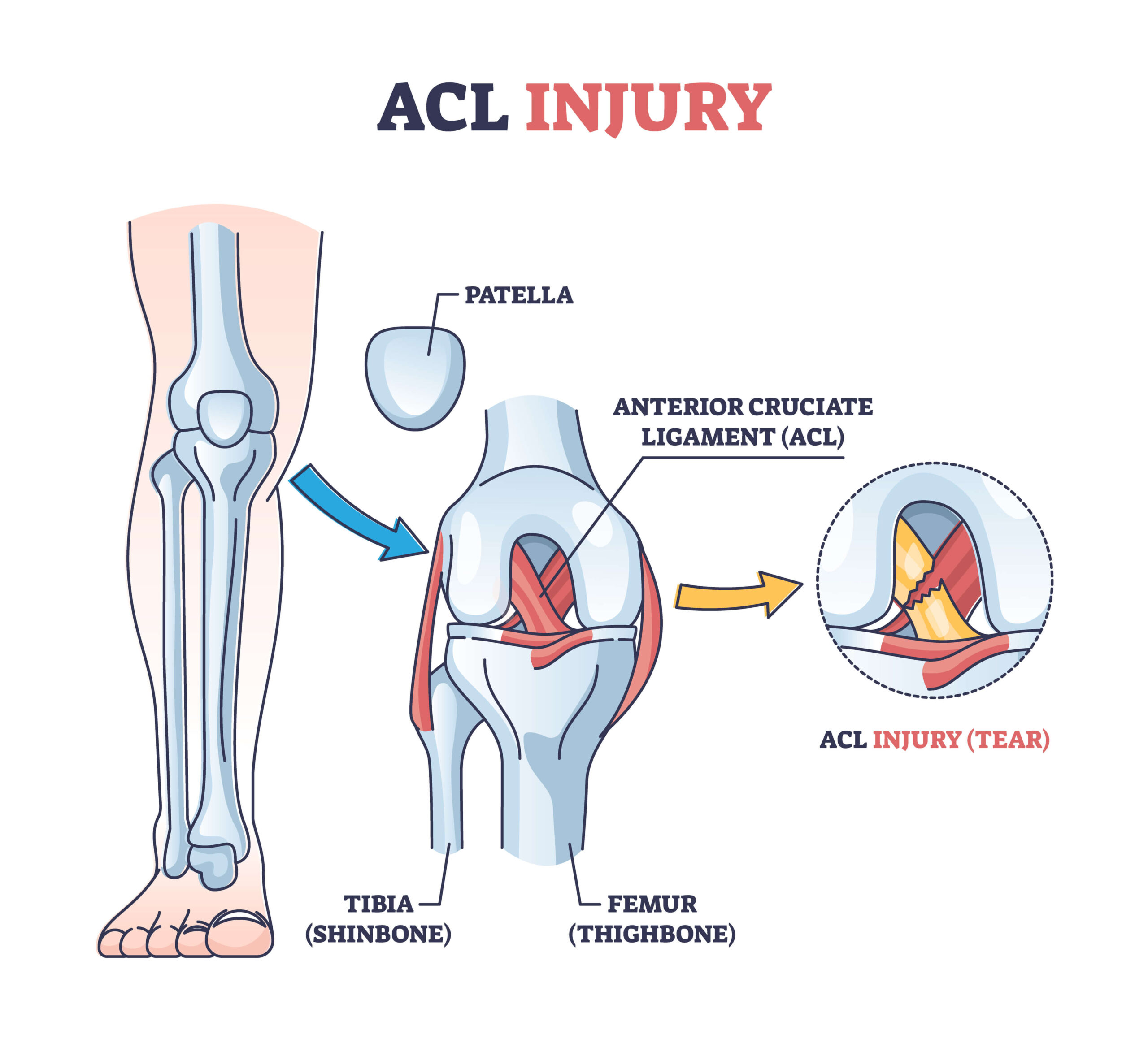 Does Stretching Prevent ACL Injury?