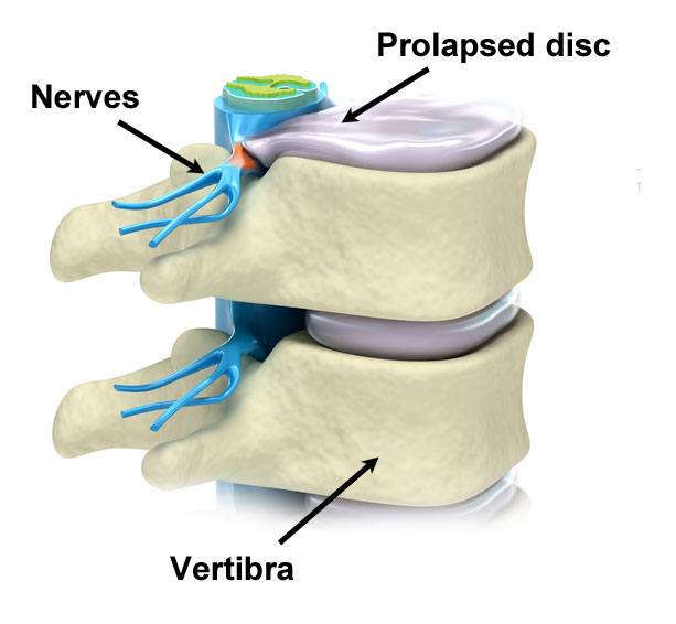 What Causes a Prolapsed Disc?