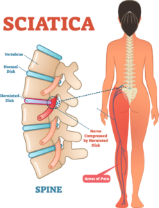 Can Constipation Cause Sciatica Pain?