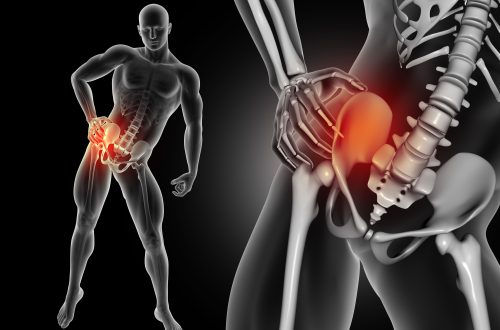 how to rid of sciatica pain