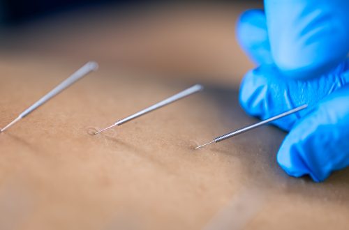 What is Dry Needling