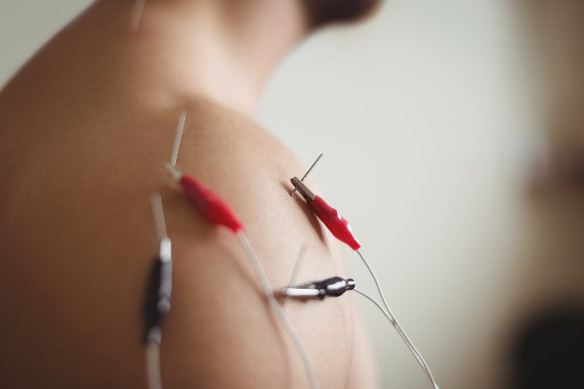 does dry needling increase blood flow