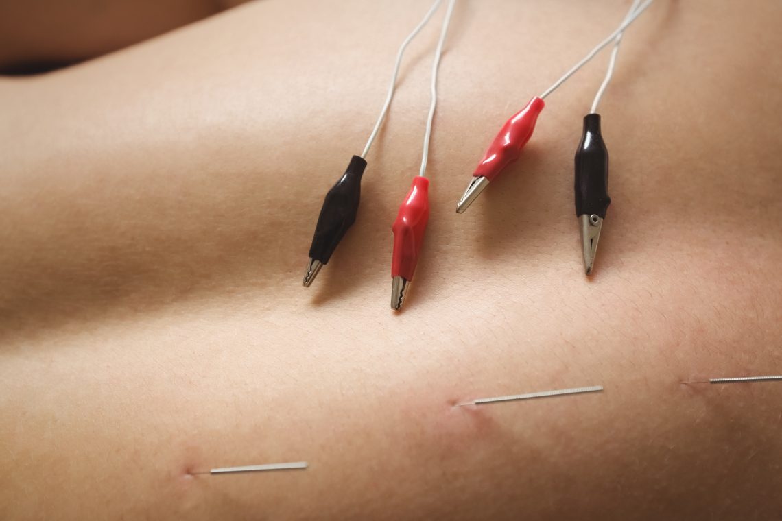 is acupuncture and dry needling the same