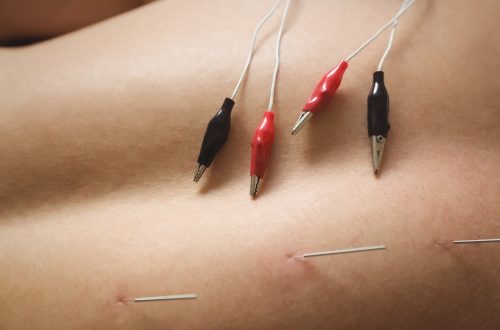 is acupuncture and dry needling the same